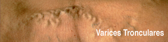 tratamentul marginilor varicoase de scleroterapie varicoza i mumina tratament